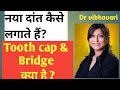 Difference between tooth cap &amp; bridge .. missing tooth replace कैसे करें ..