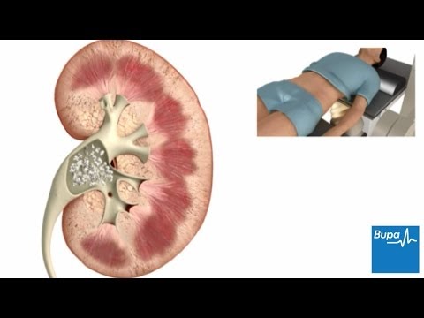 Video: Is schokgolftherapie voor niersteen veilig?