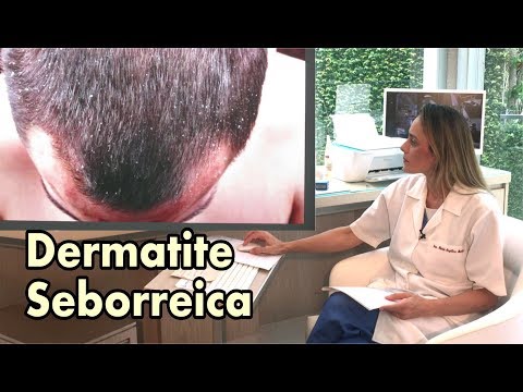 Vídeo: 3 maneiras de tratar dermatite seborréica