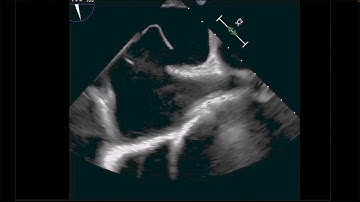 Transesophageal Echocardiogram Detecting a High-Risk Patent Foramen Ovale