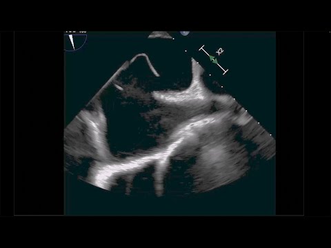 Transesophageal Echocardiogram Detecting a High-Risk Patent Foramen Ovale