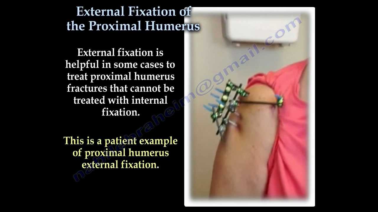 External Fixation Device Nursing Care