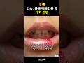 입 상처엔 로우레벨 레이저 테라피 #덕천치과 #화이트이치과