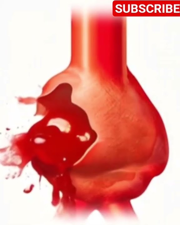 Abdominal Aortic Aneurysm Rupture