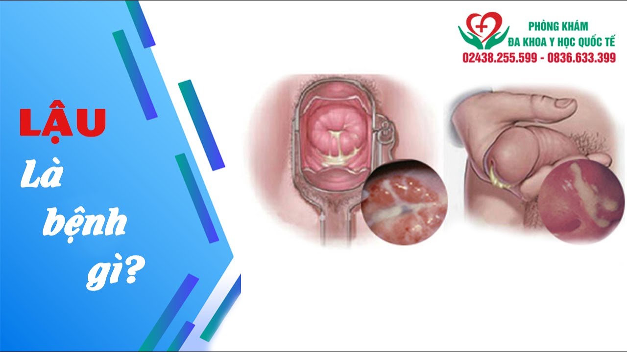 BỆNH LẬU: NGUYÊN NHÂN, ĐƯỜNG LÂY, DẤU HIỆU NHẬN BIẾT | Tổng hợp những thông tin về benh lau va giang mai chuẩn nhất