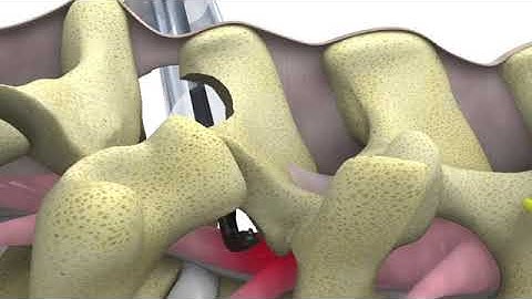 Carevature Medical: Crossover Technique using Dreal