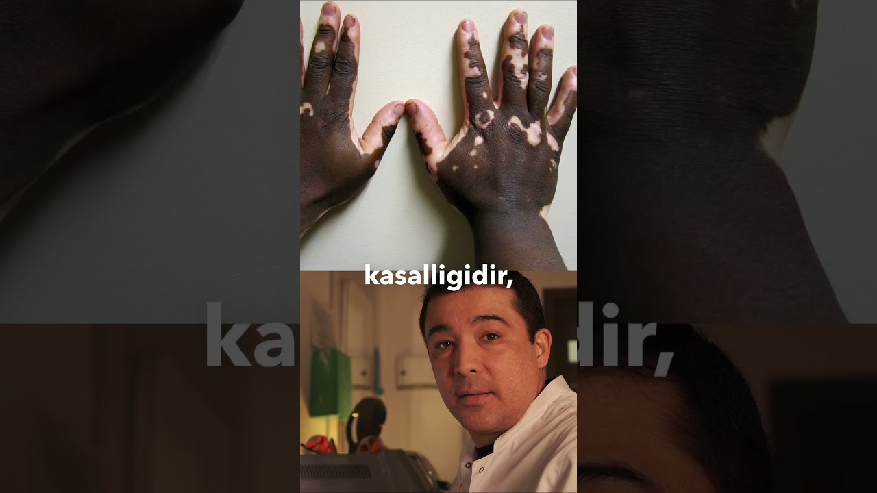 VITILIGONI DAVOSI BORMI?