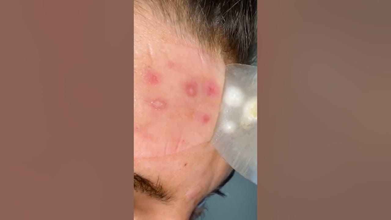 Blackheads loan nguyen 2022 Cystic acne and blackheads removal YouTube