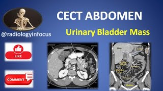 Urinary bladder mass RadiologyinFocus