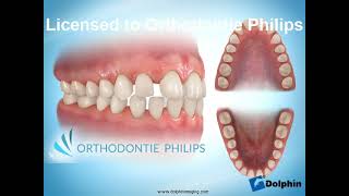 Le traitement orthodontique chez l'adulte : différents appareillages  proposés au cabinet d'orthodontie