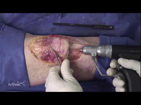 Video: Kneefraktur