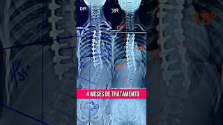 TRATAMENTO DA ESCOLIOSE #escoliose #escolioseidiopatica