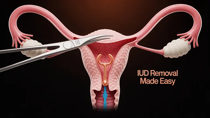 Intrauterine Device (IUD) Copper T Removal procedure | Patient Education Medical animation USMLE