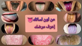 من تغيير لون لسانك 👅 إعرف نفسك بتشتكي من ايه #اللسان