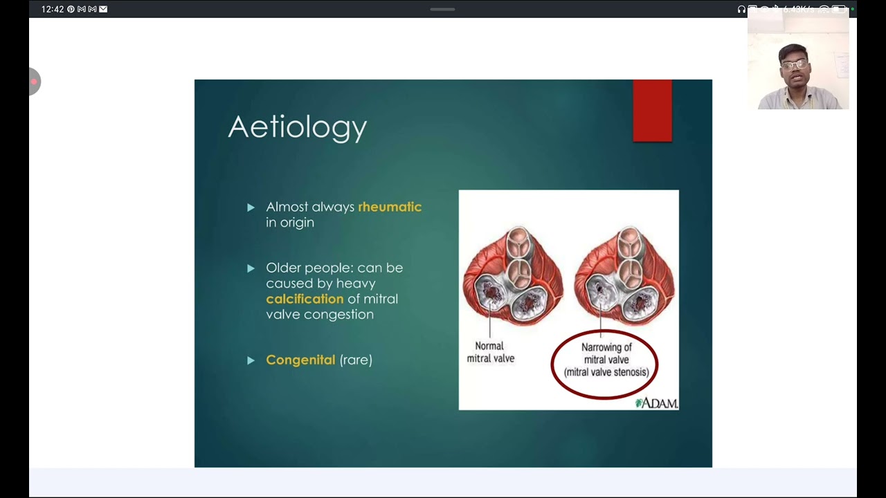 Valvular Heart Disease | Causes | Sign & Symptoms | Pathophysiology | Diagnosis | Management 