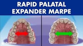 Rapid PALATAL expander MARPE  This ORTHODONTIC device can EXPAND the PALATE in adults©