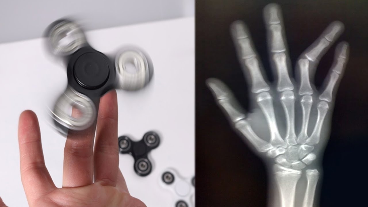 Fidget spinner: conoce los riesgos ocultos del juguete de moda