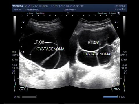 Ultrasound Video showing