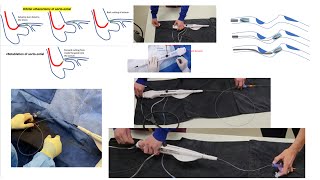 Rotational atherectomy: advanced techniques with videos + Orbital atherectomy tips- Elias Hanna