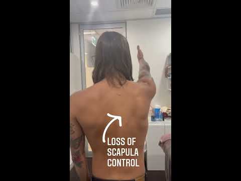 Here Is Some Pretty Extreme Evidence Of Loss Scapula Control And Winging 