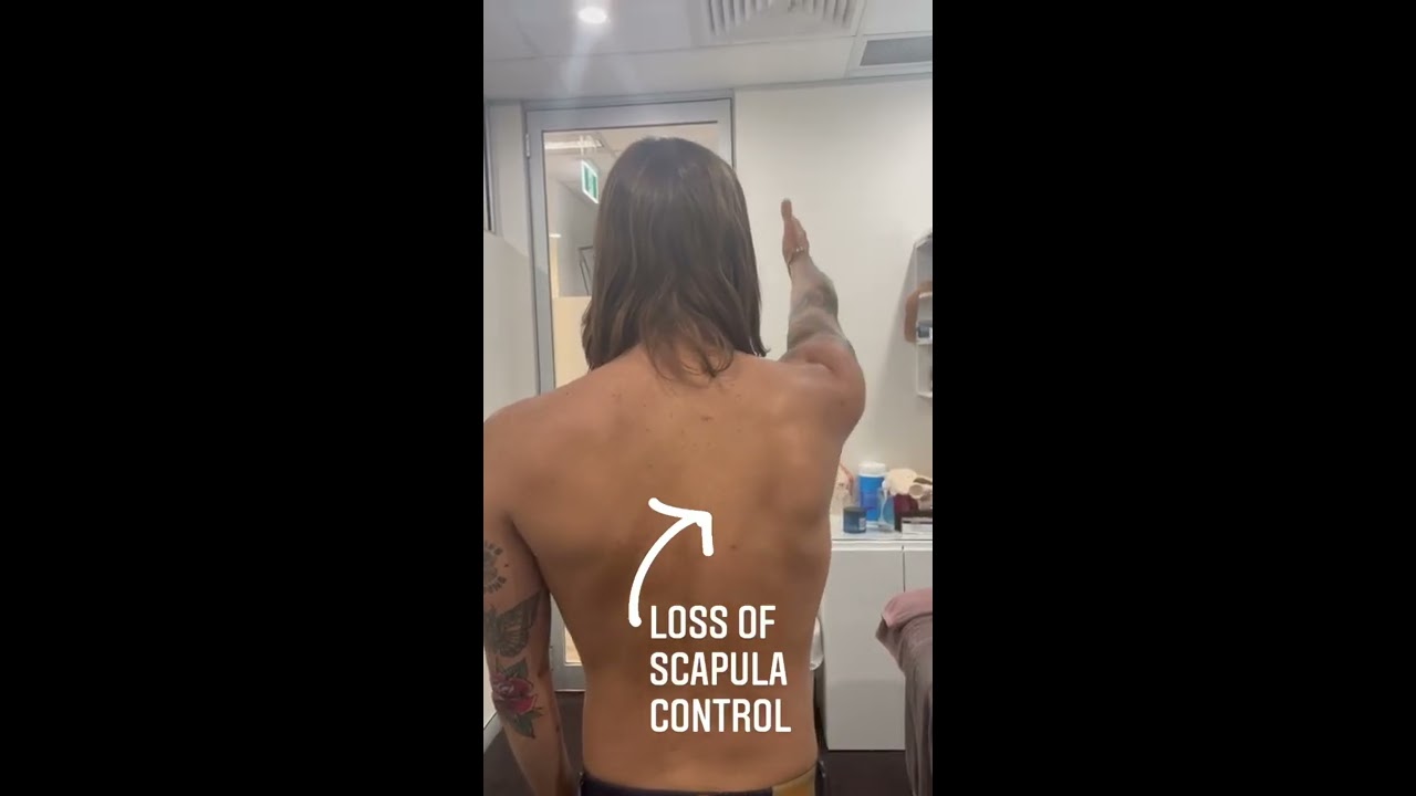 Here Is Some Pretty Extreme Evidence Of Loss Scapula Control And Winging 
