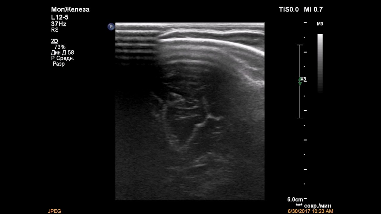 Кефалогематома - YouTube