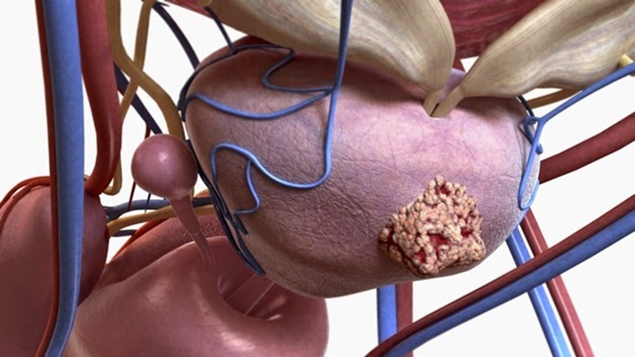 Como Desinflamar La Prostata Con Los 4 Mejores Remedios Naturales | Hiperplasia Prostatica medicina natural para la gastritis