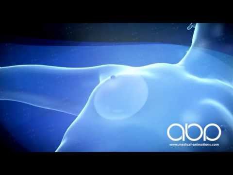 Keyhole breast implant surgery