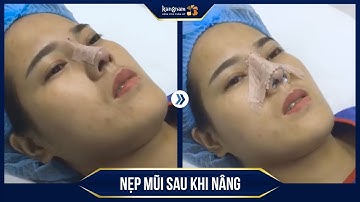 Nẹp mũi sau khi nâng: Hiểu rõ tác dụng và thời gian tháo nẹp
