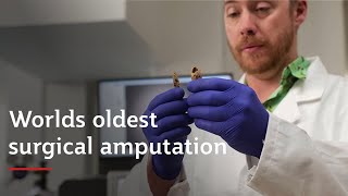 Griffith University Archaeologists discover worlds oldest surgical amputation