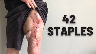 They Took Seven Inches Of Blood Vessel From Me