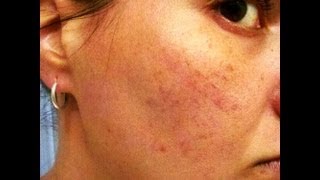 HOW TO COVER ACNE, SCARS AND BIRTHMARKS WITH MAKEUP.