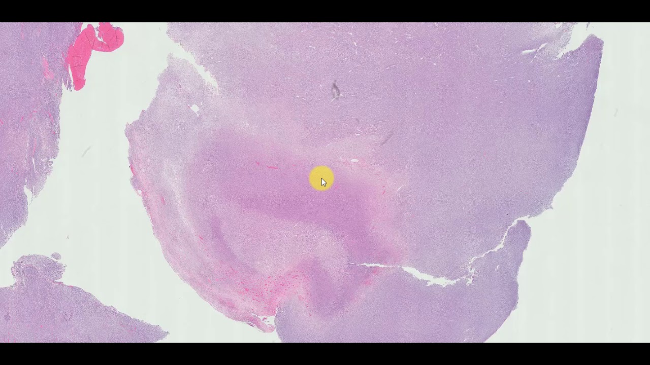 Spindle cell/sclerosing YouTube