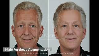 Facial Plastic Surgery For Men Seattle Wa Joseph Shvidler Md