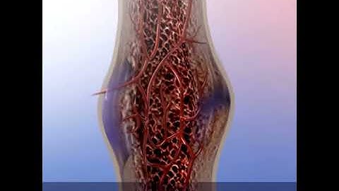 Bone Fractures: Proper Healing