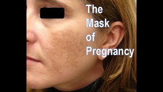 Melasma (The Mask of Pregnancy), Lichen Simplex Chronicus and What the Heck Is Eczema?