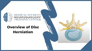 Overview of Disc Herniation Information