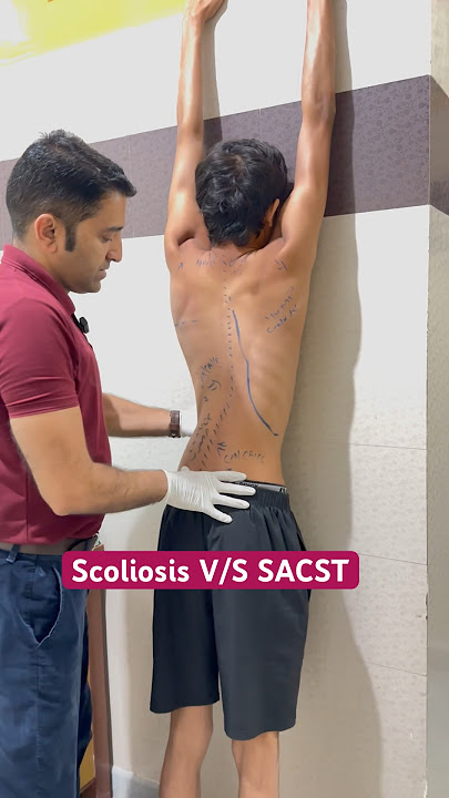 Best Scoliosis Exercise By DrRavi #reels #scoliosis #kyphosis #chiropractic #shorts #doctor #schroth
