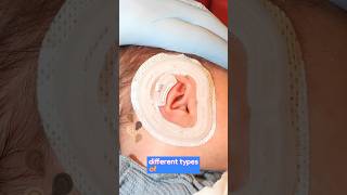 Non-surgical Ear Molding