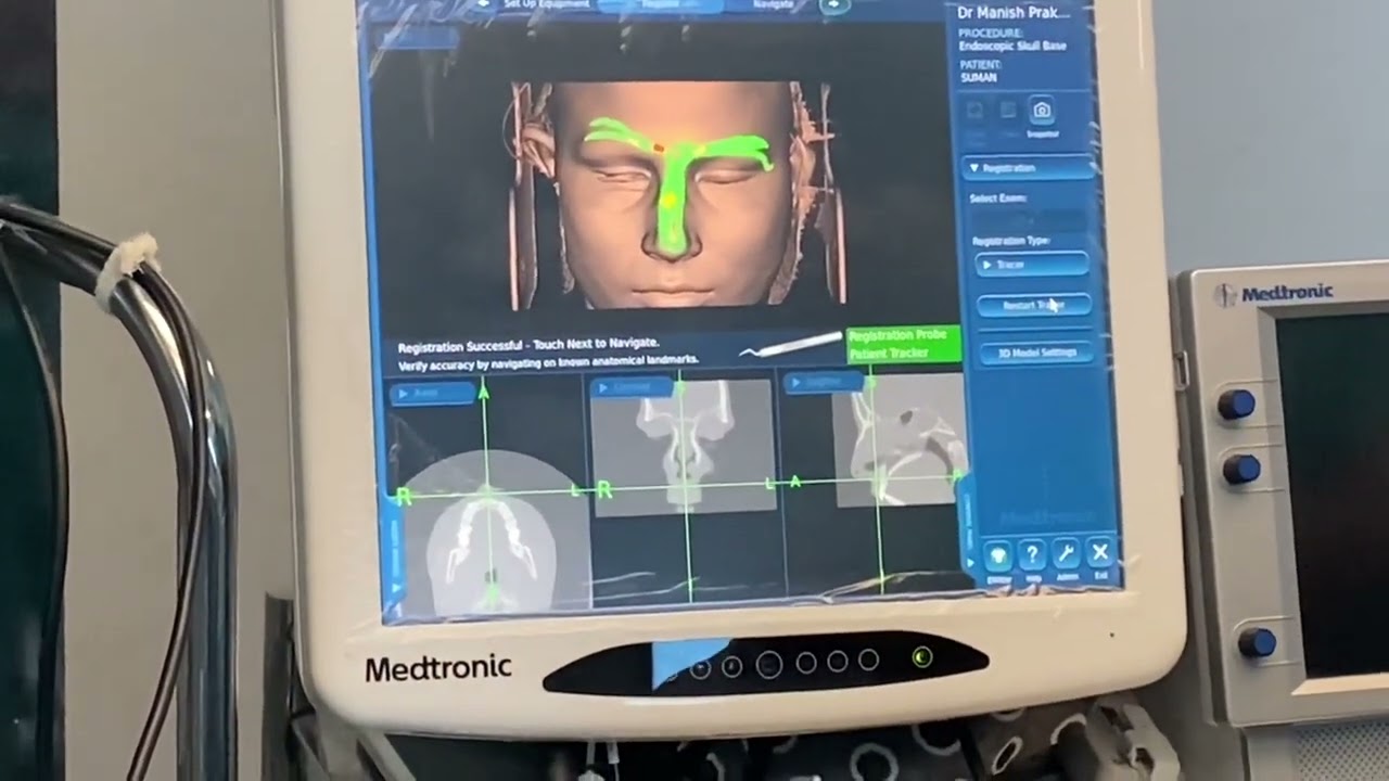 Navigation Guided Safe Sinus Surgery set up Medtronic Navigation