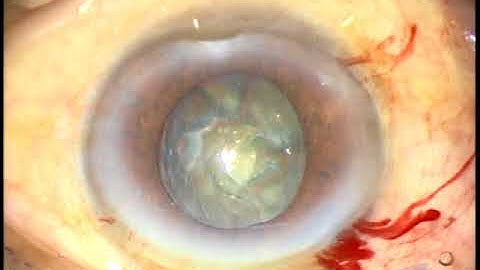 Small pupil : Nucleus management without pupil dilating device - P Mohanta