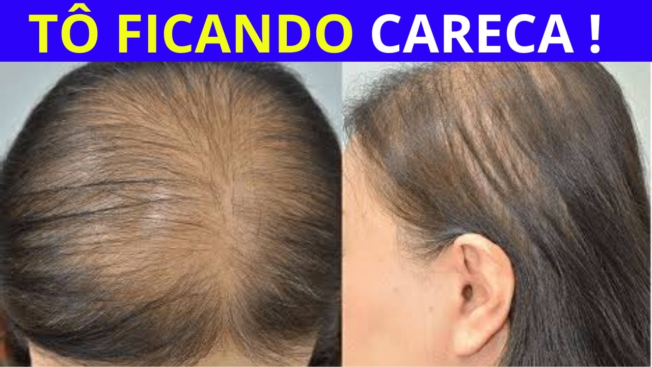 Выпадают волосы у женщины сильно на голове. Андрогенная алопеция алопеция. Дарсонваль алопеция андрогенная. Редкие волосы у женщин.