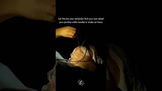 Enhance Your Jawline in 1 Hour | Submental Liposuction