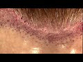 Female BrowLift Scar Correction/Hairline Lowering Hair Transplant Dallas