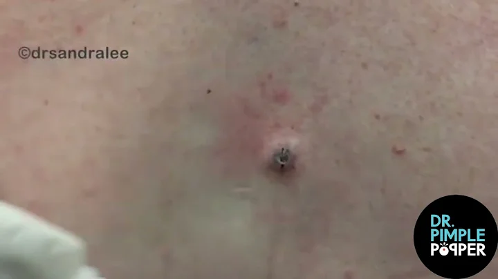 8 Minutes of Satisfying Soft Pops! Dr Pimple Popper POPS All Over The Body!