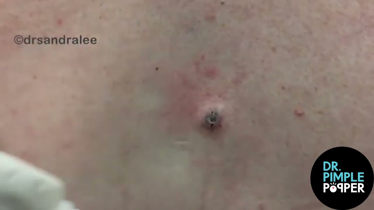8 Minutes of Satisfying Soft Pops! Dr Pimple Popper POPS All Over The Body!