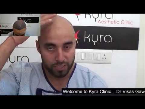 Revitalize Studios  Hair Transplant Centre in Jalandhar Punjab India  Hair  Transplant before and after resultWe have delivered best hair transplant  result in jalandhar  Revitalize Studios   Visit  httpsbitly2O6QXAr