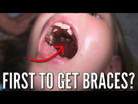 Finally, Someone is Getting Braces...and Separators, and an Expander! | Who Is the Lucky One??