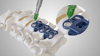 RESONATE™ Anterior Cervical Plate System