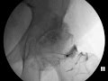 Hip injection under fluoroscopic guidance  thepainsourcecom